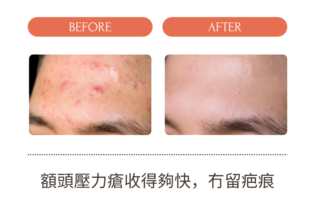毛孔隱形滅痘膏(升級組)