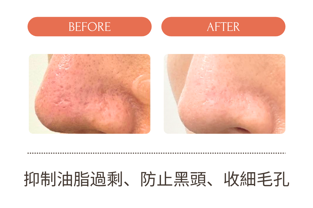 毛孔隱形滅痘膏(升級組)